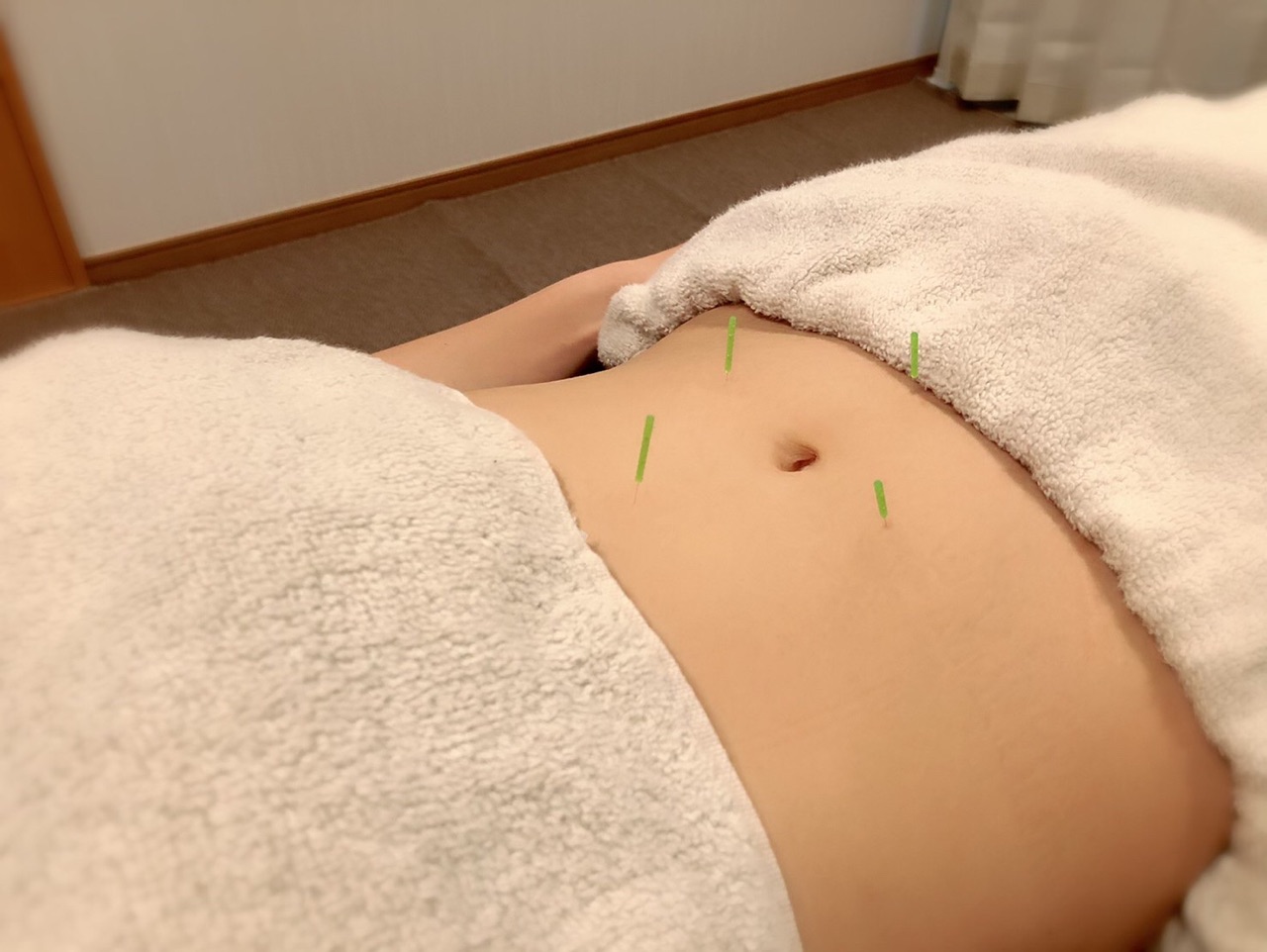 美容鍼 千葉県旭市 増田鍼灸整体院